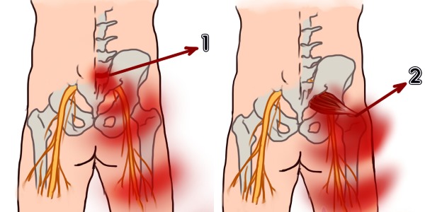При ишиалгии боль носит различный характер, однако локализация одинакова