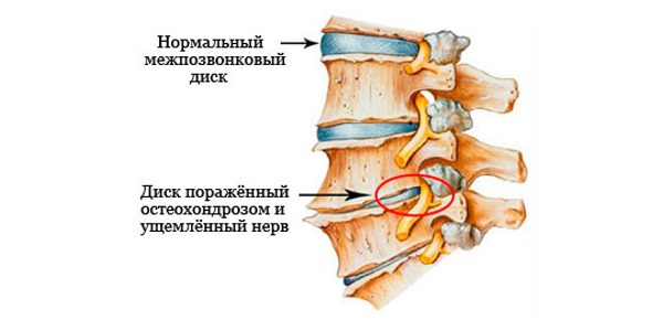 Защемление нерва также сопровождается стреляющими болями в спине