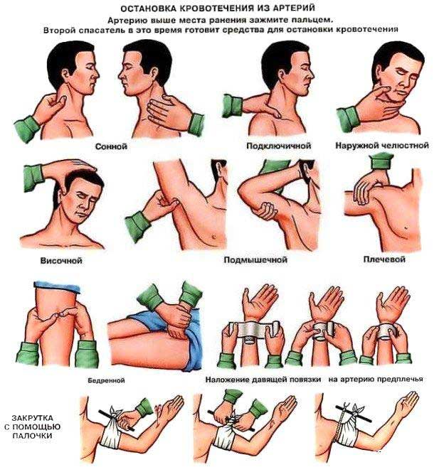 зажатие артерий