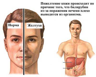 желтуха