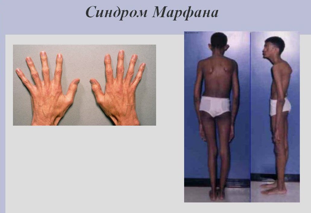 Больной с синдромом Марфана
