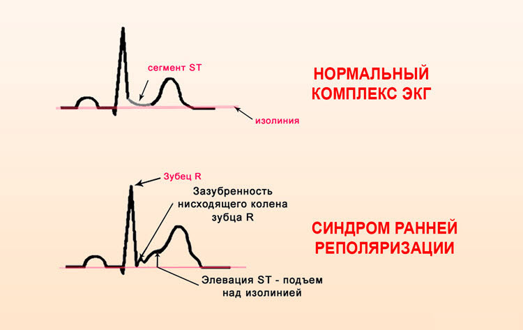 ЭКГ при ранней реполяризации желудочков