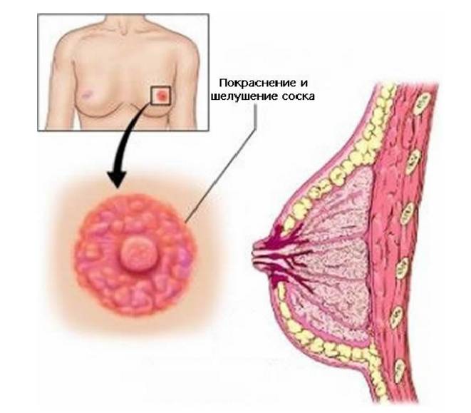 сосок покраснел сосок покраснел