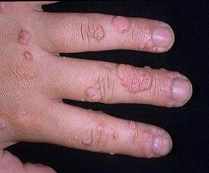 бородавки фото