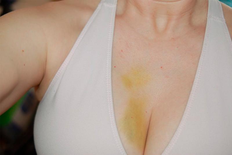 синяк на груди синяк на груди