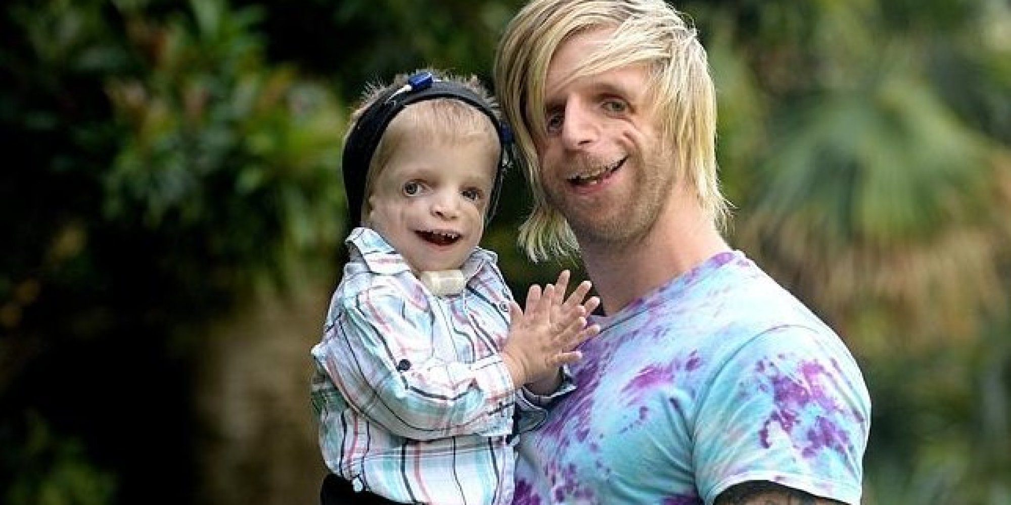 Отец и ребенок с синдромом Тричера Колинза