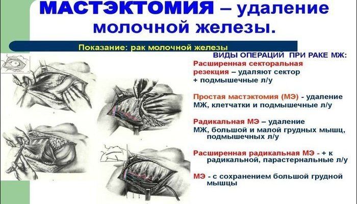 Мастэктомия