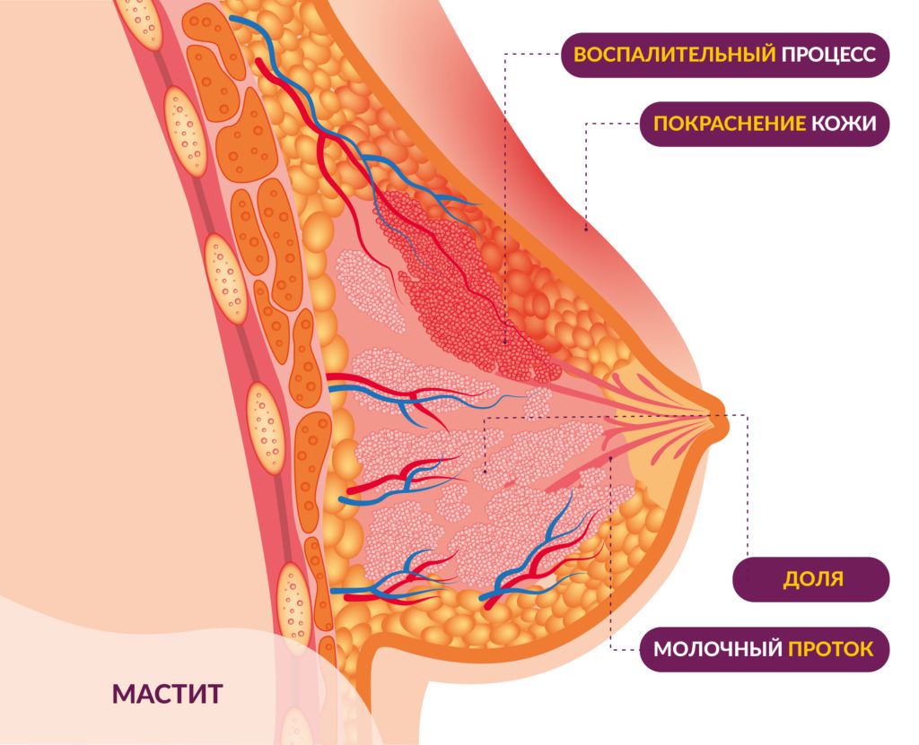 как выглядит мастит как выглядит мастит