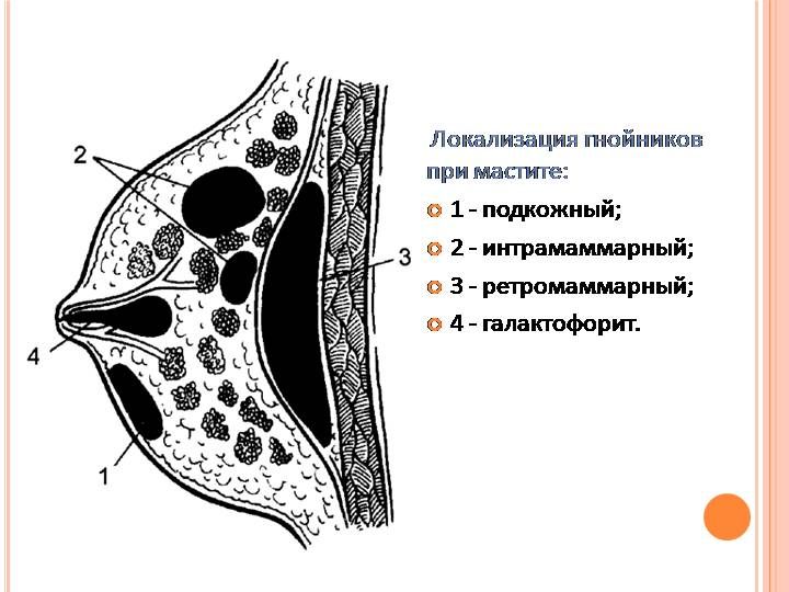 локализация мастита локализация мастита