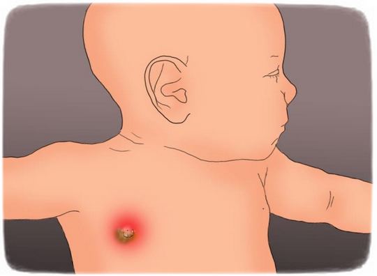 мастит у ребенка мастит у ребенка