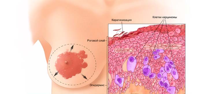 рак Педжета рак Педжета