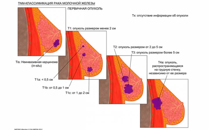 стадии рака груди стадии рака груди