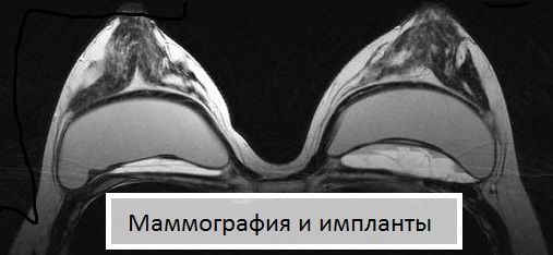 Маммография и импланты