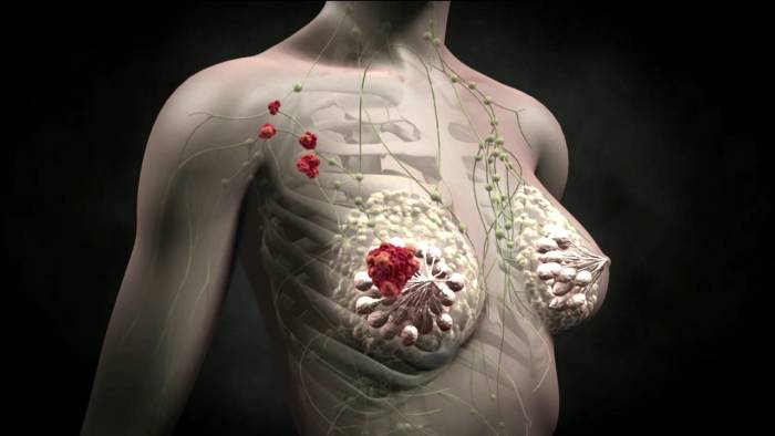 метастазы рака груди метастазы рака груди