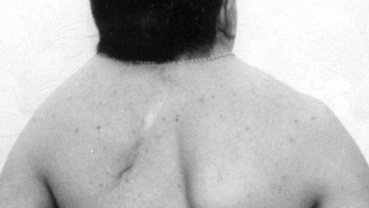 Синдром Клиппеля Фейля