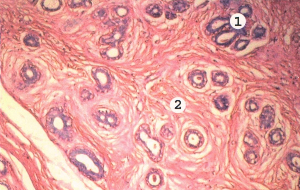 Периканаликулярная фиброаденома Периканаликулярная фиброаденома