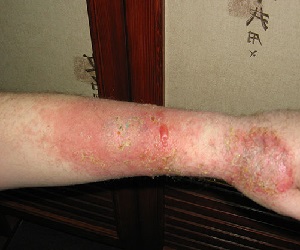 мокнущая экзема фото