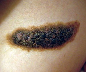 пигментный невус лечение