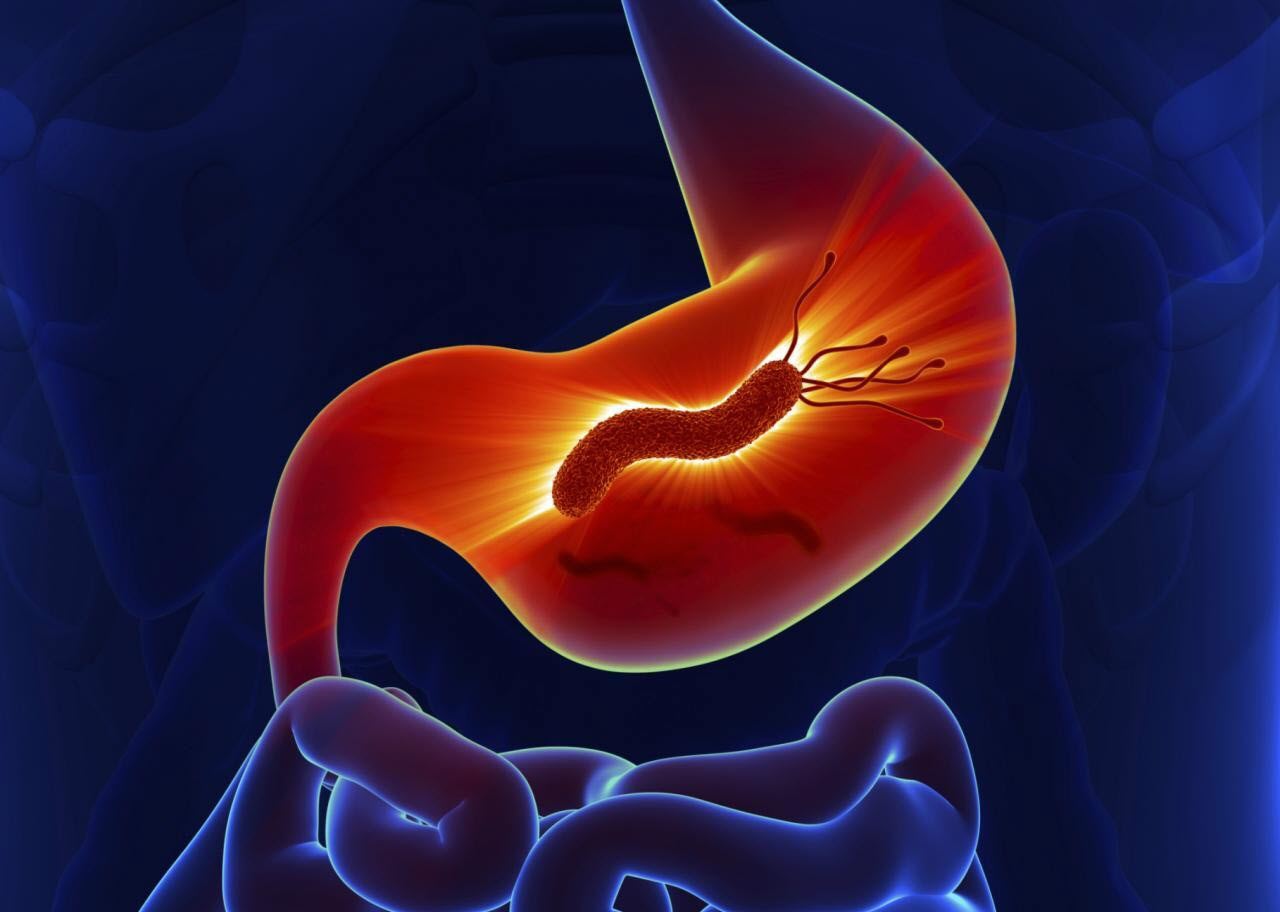 Язва желудка