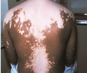 витилиго фото