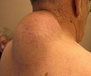 липома на шее фото