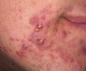 прыщи на щеке что означают