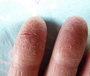 трещины на пальцах рук фото