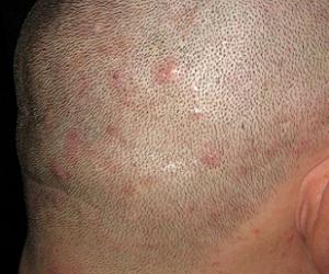 прыщи на голове фото