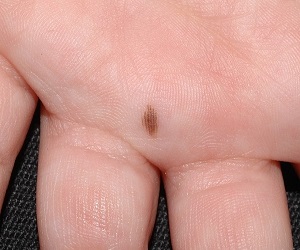 родинка на левой ладони у женщин