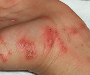 чесотка фото симптомы и лечение