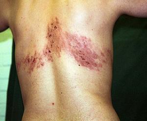 опоясывающий герпес фото