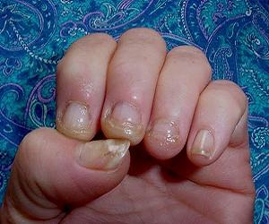 грибок ногтей на руках фото