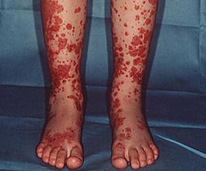 геморрагический васкулит причины лечение фото