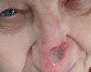 базалиома кожи носа фото