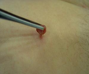 папиллома фото