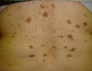 солнечный кератоз фото