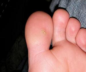 шипица на ступне как лечить фото