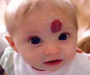 гемангиома на голове у новорожденного фото