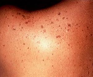 лентиго фото