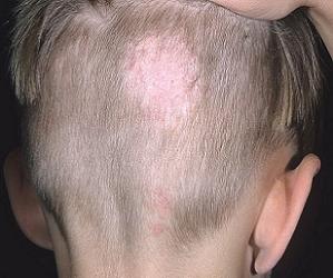 стригущий лишай у человека фото начальная стадия