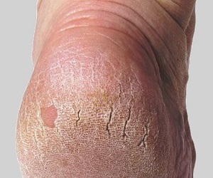 трещины на пятках фото