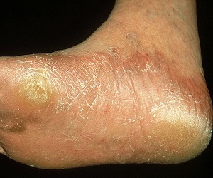 микоз стоп лечение препараты