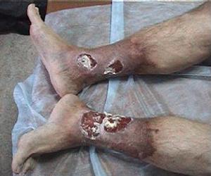 трофические язвы нижних конечностей фото