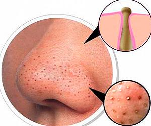 комедоны на лице фото