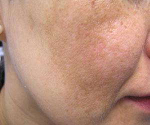 мелазма на лице фото