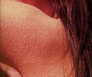 гусиная кожа на руках причины фото