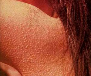 фолликулярный кератоз фото у детей