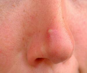 красный прыщ как избавиться фото