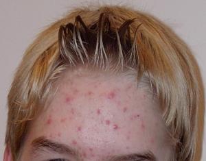 прыщи на лбу фото