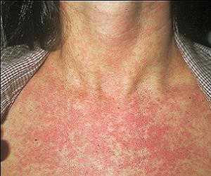 краснуха симптомы у взрослых фото